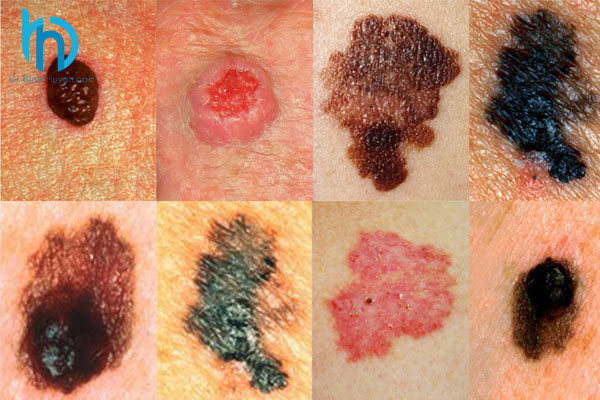 Ung thư biểu mô tế bào đáy (BCC) - Hình ảnh minh họa